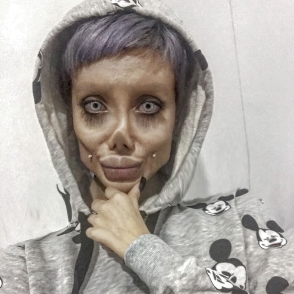 Дівчина пережила 50 операцій, щоб стати схожою на Джолі: ось що з цього вийшло