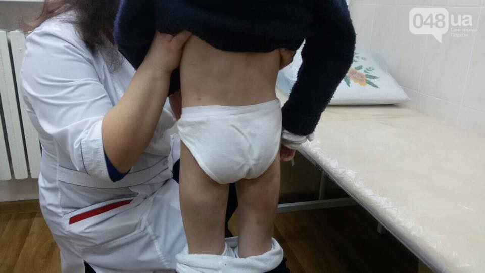 Б'є батько: під Одесою медсестра помітила гематоми на тілі семирічної дівчинки