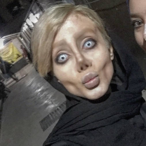 Дівчина пережила 50 операцій, щоб стати схожою на Джолі: ось що з цього вийшло