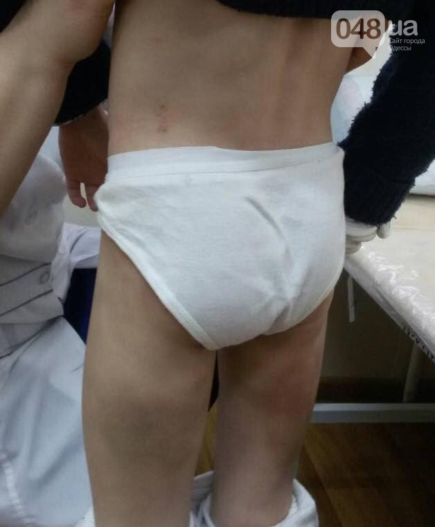 Б'є батько: під Одесою медсестра помітила гематоми на тілі семирічної дівчинки