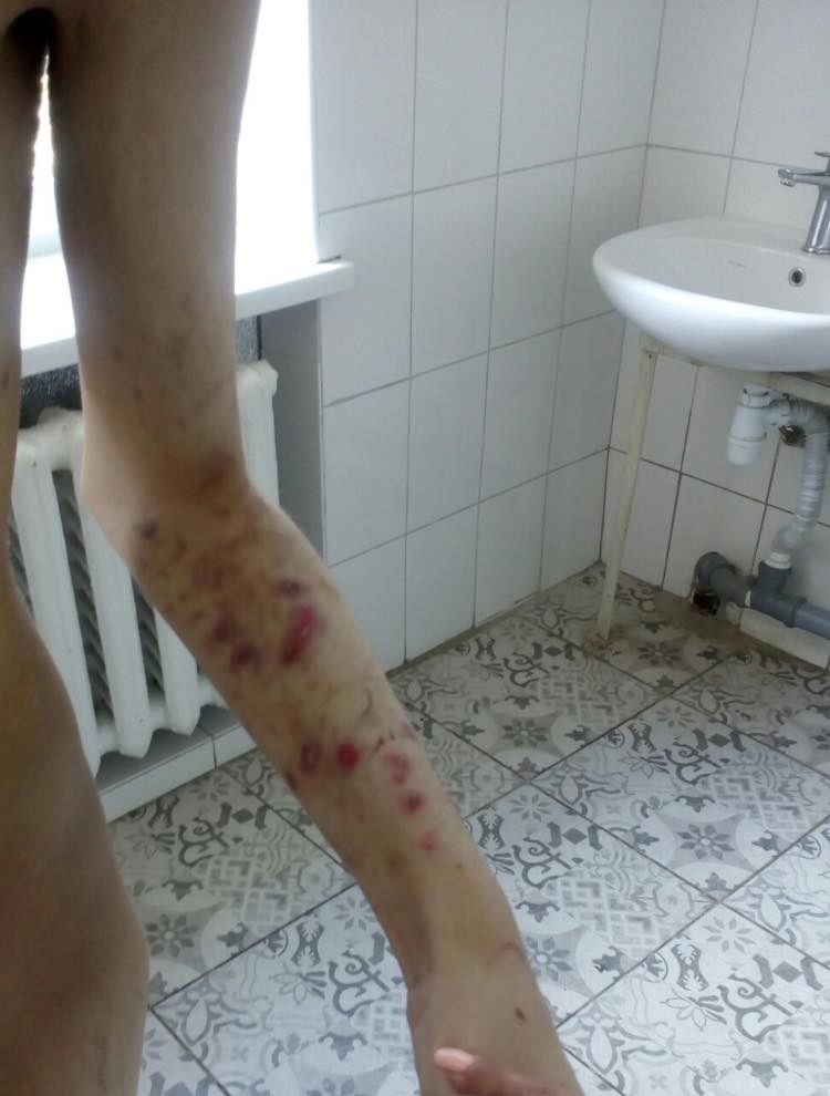 В киевском интернате жестоко издевались над детьми: тела черные от побоев (фото 18+)