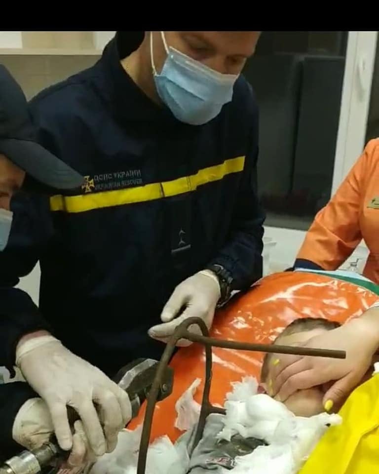 В Полтаве из шеи мальчика достали кусок арматуры: родился в рубашке