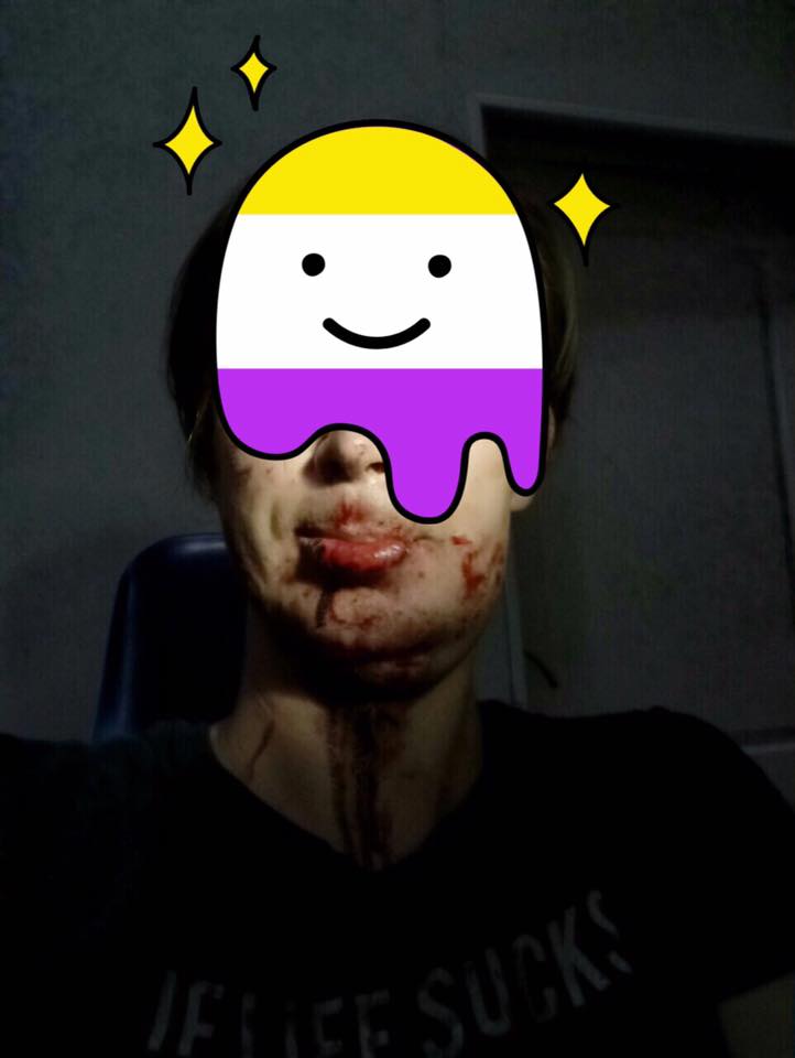 В центре Одессы из-за ямы на дороге разбился велосипедист