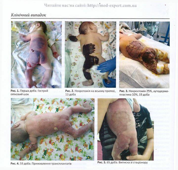 В Одесі лікарі врятували новонародженого малюка, який отримав сильні опіки