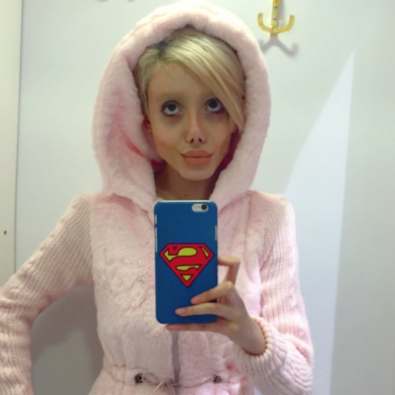 Дівчина пережила 50 операцій, щоб стати схожою на Джолі: ось що з цього вийшло