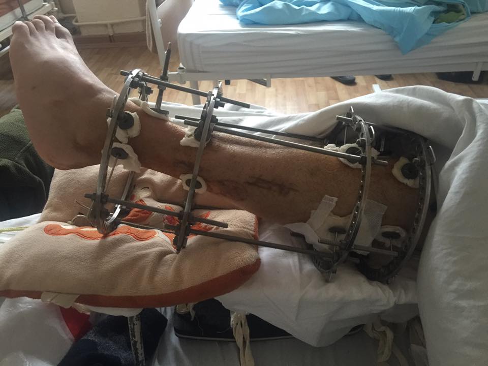 "Новости с передовой неутешительные": волонтер просит помочь тяжелораненым бойцам АТО