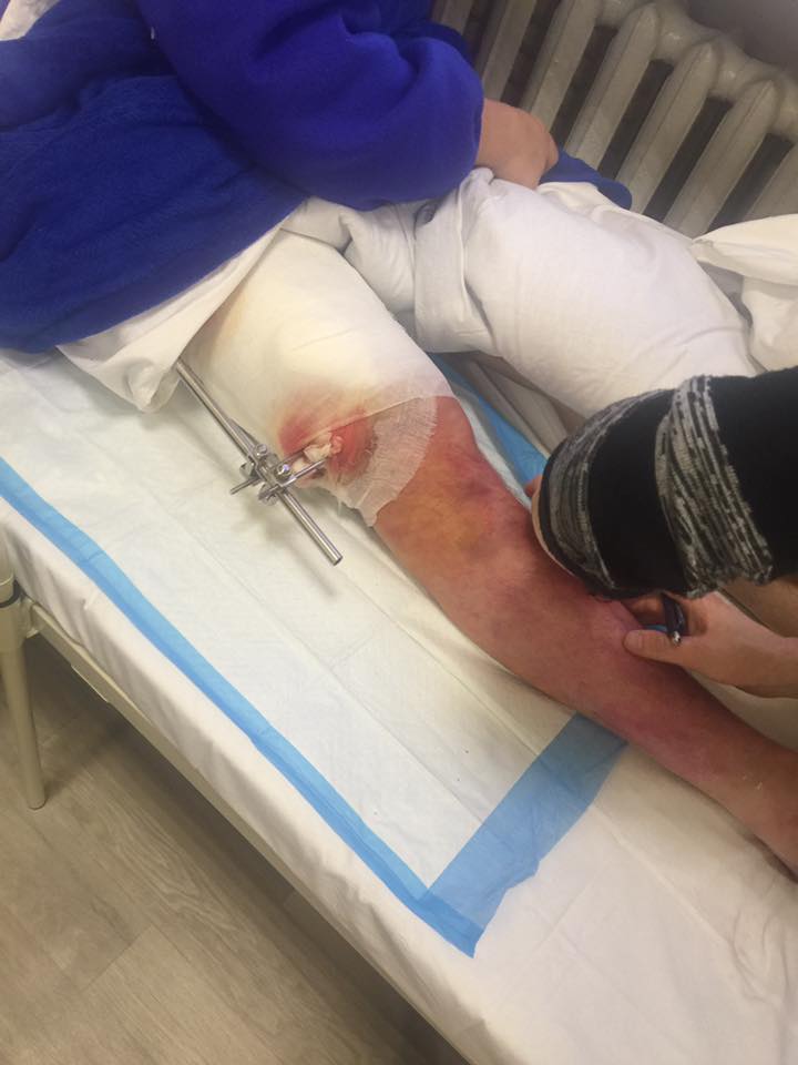 "Новости с передовой неутешительные": волонтер просит помочь тяжелораненым бойцам АТО