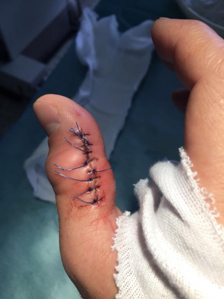 Шовковський показав жахливі травми після 35-річної футбольної кар'єри (фото)