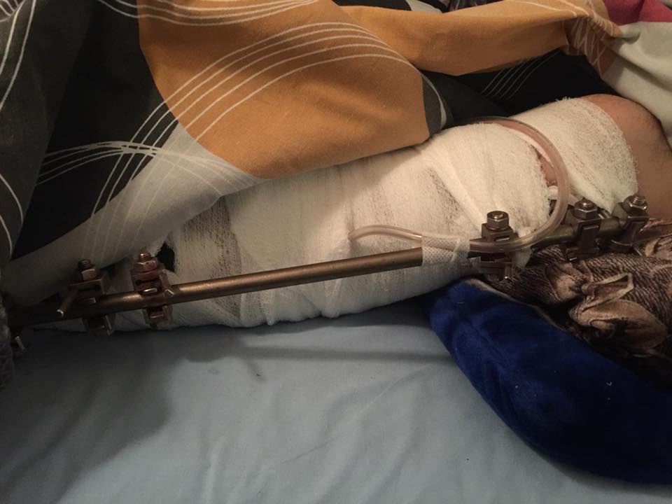 &quot;У болю і ран свят немає&quot;: відома волонтер нагадала про поранених бійців