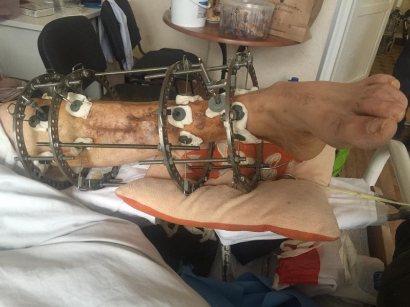 "Война не заканчивается": волонтер напомнила о раненых бойцах АТО, нуждающихся в помощи