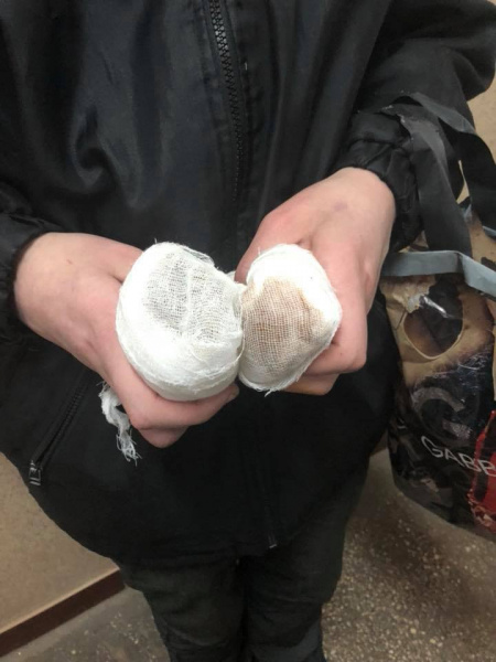 "Задерживают уже в третий раз": в Черновцах активисты "вернули отрезанные руки" попрошайке (видео)