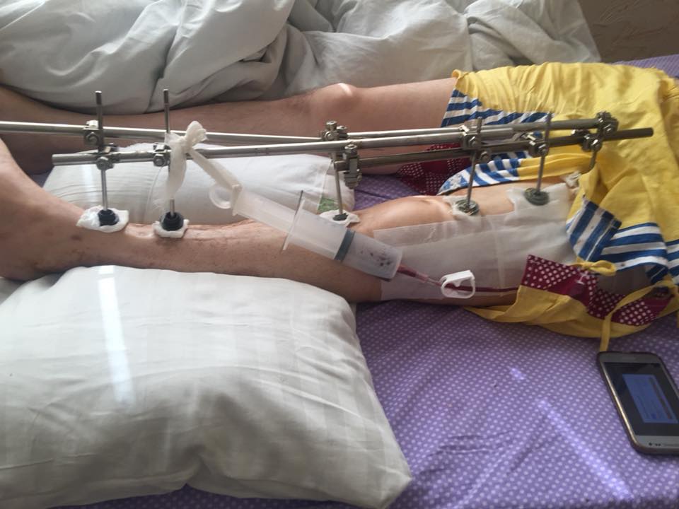 &quot;Перемирие&quot; во всей красе&quot;: волонтер просит помочь раненым бойцам АТО (фото)