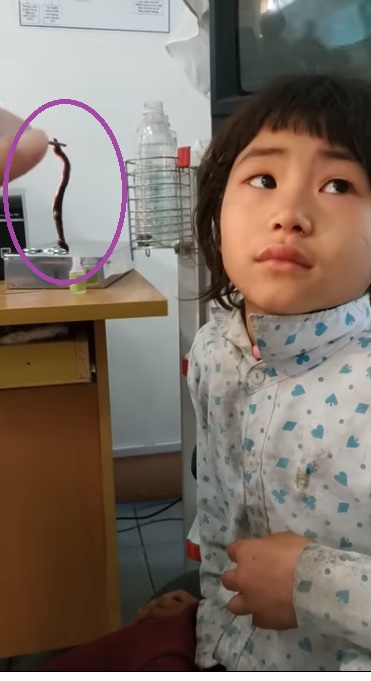 Оно шевелится: доктор извлек из шестилетней девочки нечто омерзительное (видео)