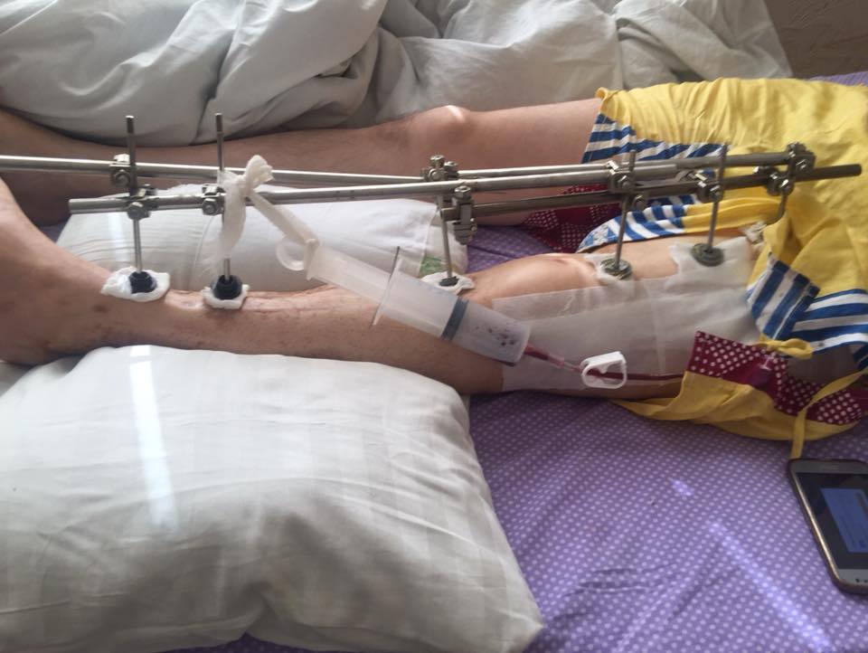 "Наша совместная боль": волонтер сообщила, что в Киев доставили новый борт с ранеными воинами