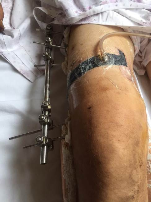 "Ситуация на войне не радует": волонтер призвала помочь бойцам в киевском госпитале