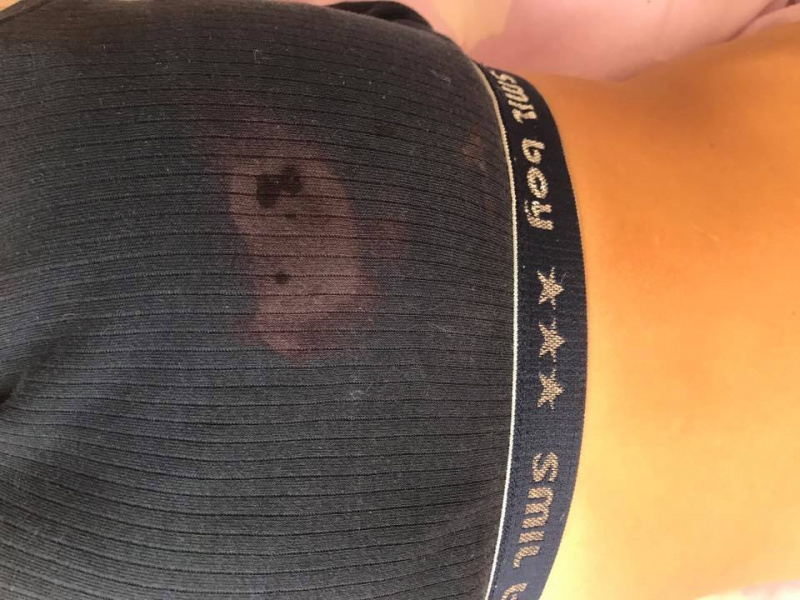 "Это ожог, даже трусы выгорели": в Киеве вспыхнул медицинский скандал из-за укола ребенку (фото)