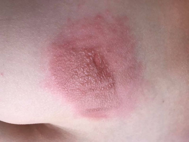 "Это ожог, даже трусы выгорели": в Киеве вспыхнул медицинский скандал из-за укола ребенку (фото)