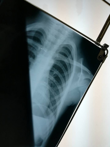 Знайшов в супі дріт: у київському дитсадку скандал