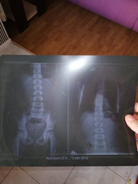 Знайшов в супі дріт: у київському дитсадку скандал