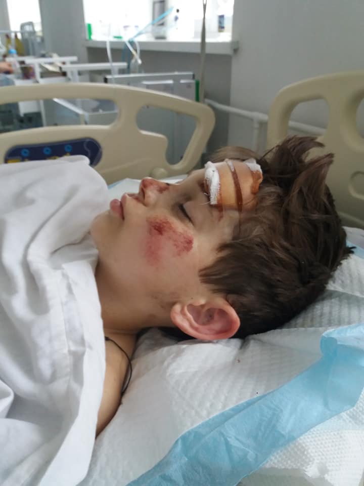 "Дригає ручками": у якому стані хлопчик, якого збило авто в Черкасах