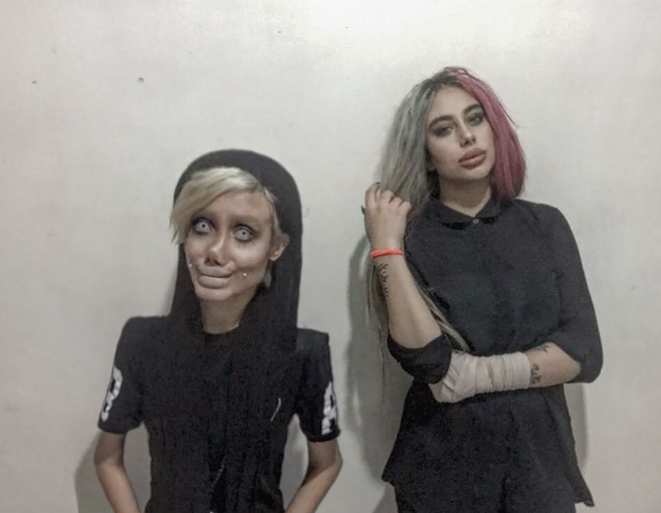 Дівчина пережила 50 операцій, щоб стати схожою на Джолі: ось що з цього вийшло