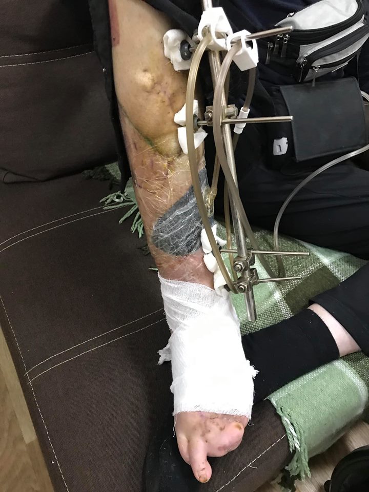 Помогите нашим защитникам: в Киев прибыл борт с ранеными бойцами