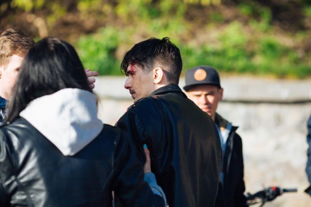 Позитив из "Время и Стекло" серьезно травмировался на съемках клипа (фото)