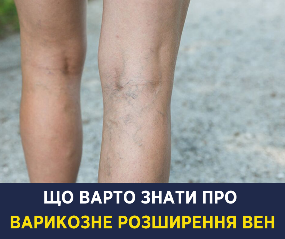 Намагаються лікувати кремами: Супрун розповіла про боротьбу з варикозним розширенням вен