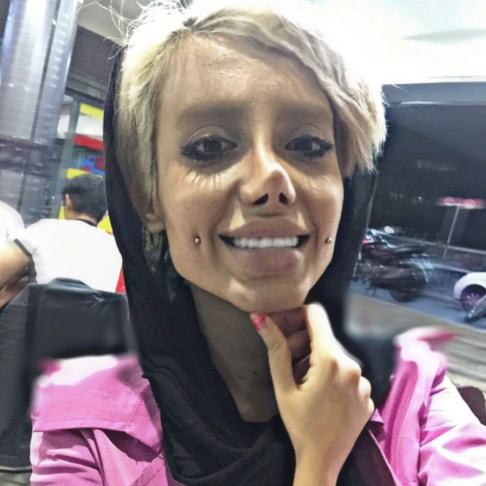 Дівчина пережила 50 операцій, щоб стати схожою на Джолі: ось що з цього вийшло