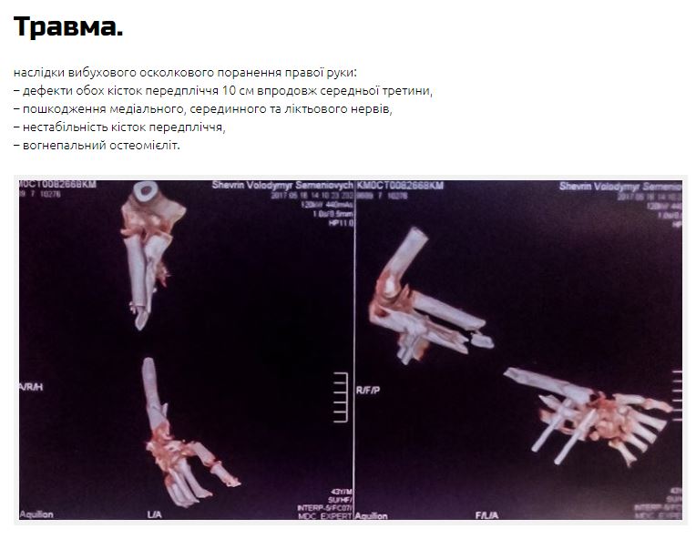 Добровольцю АТО потрібна допомога у лікуванні