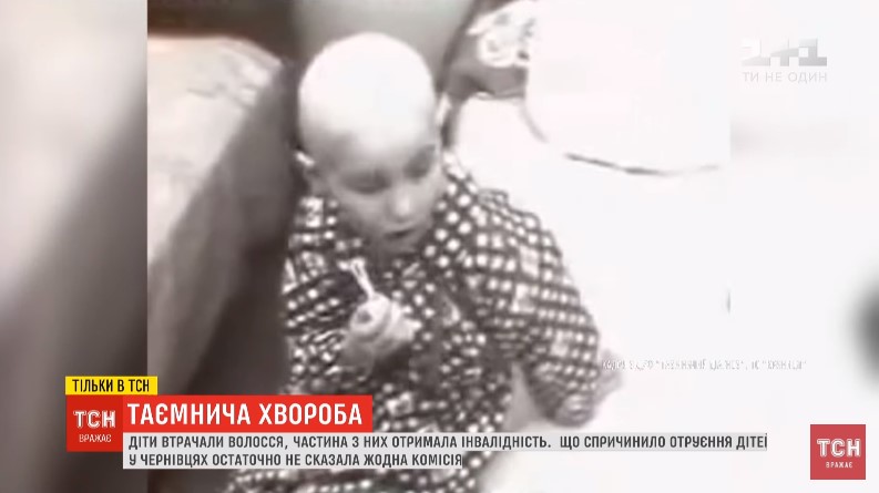 Епідемія алопеції: експерти розповіли, чому в Чернівцях полисіло понад 150 дітей