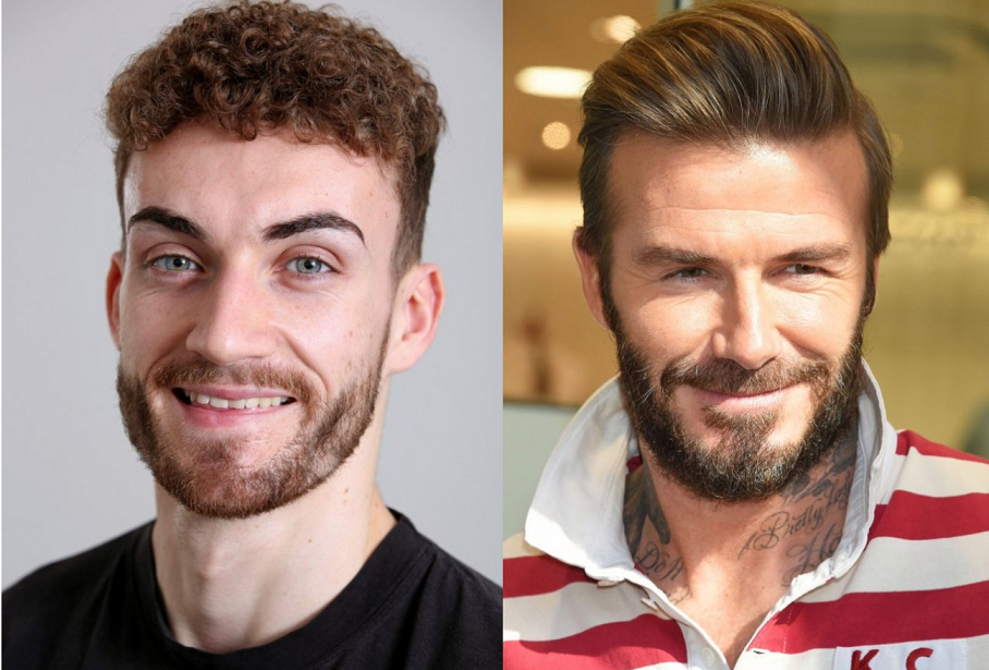 Парень из Британии ради Дэвида Бекхэма пересадил себе бороду