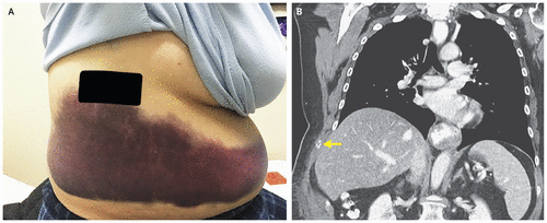 Жінка зламала ребро під час нападу кашлю (фото)