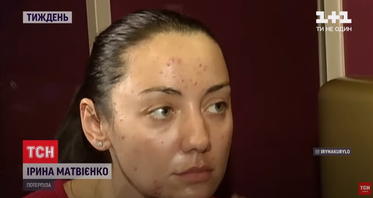 Українка розповіла, як похід до косметолога позбавив її здоров'я та квартири