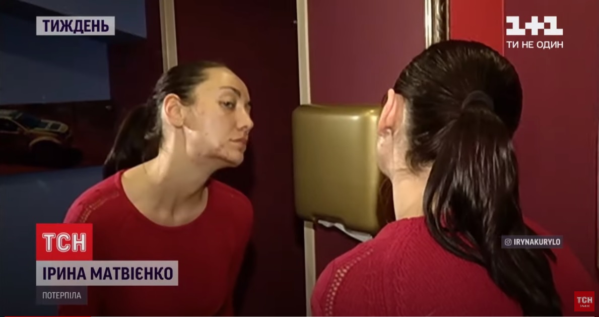 Українка розповіла, як похід до косметолога позбавив її здоров'я та квартири