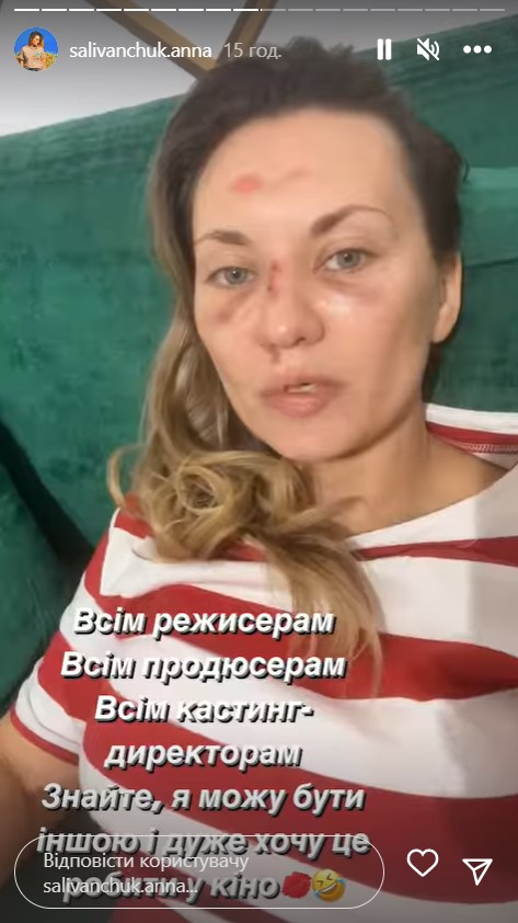 Звезда "Квартала 95" Саливанчук ужаснула фото после перелома носа и сотрясения мозга