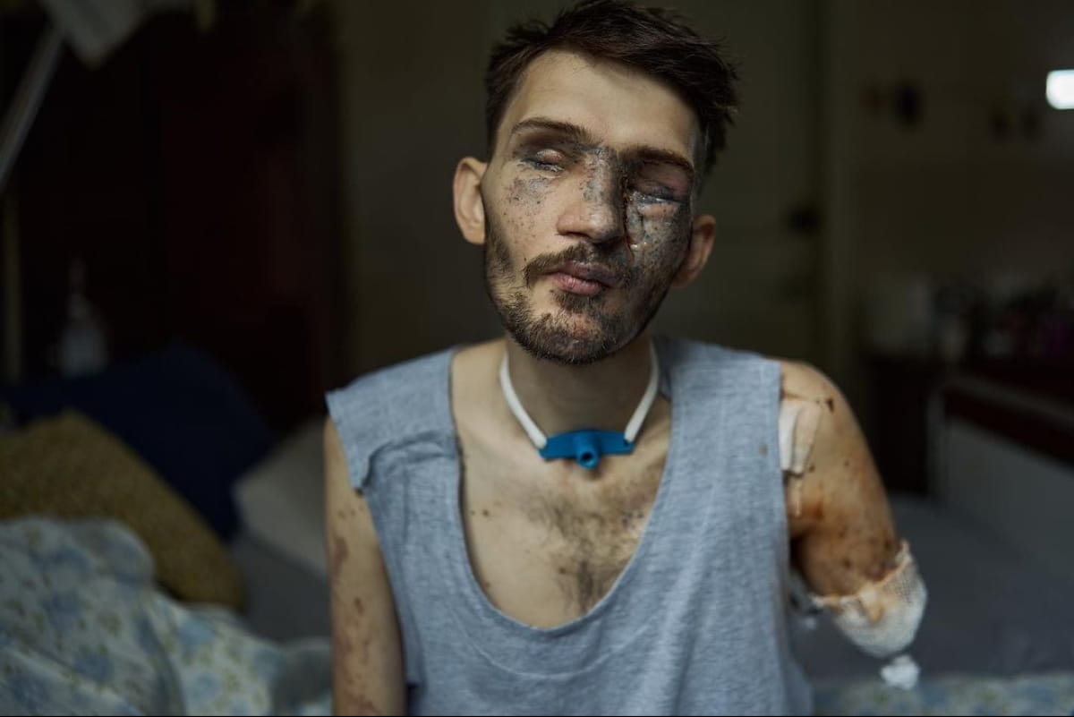 Втратив руки, зір і частково слух. Дружина пораненого воїна розчулила історією свого чоловіка