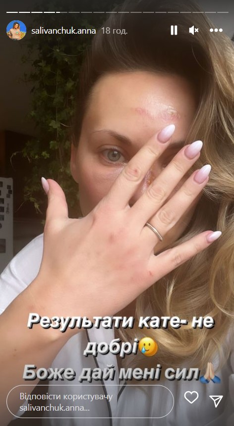 Звезда "Квартала 95" Саливанчук ужаснула фото после перелома носа и сотрясения мозга