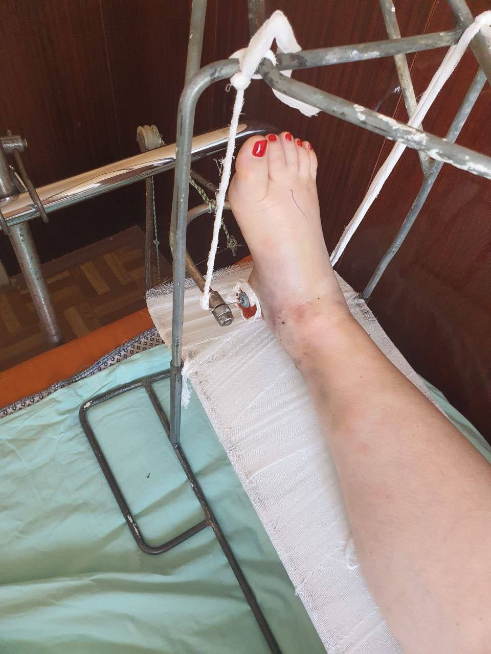 Рухатися майже не можу: Руслана Писанка розповіла про свій стан після падіння на сцені
