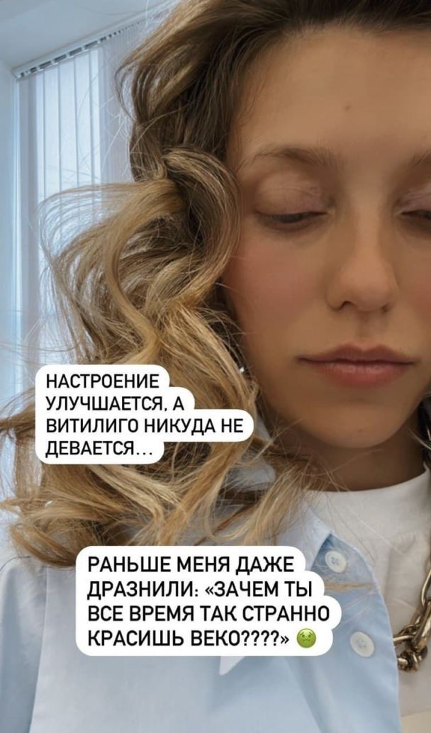 Регина Тодоренко показала неизлечимое кожное заболевание на лице
