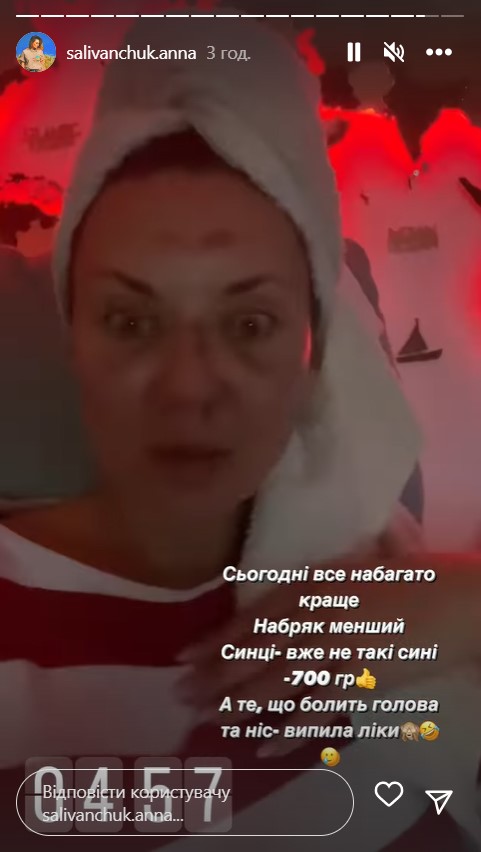 Звезда "Квартала 95" Саливанчук ужаснула фото после перелома носа и сотрясения мозга