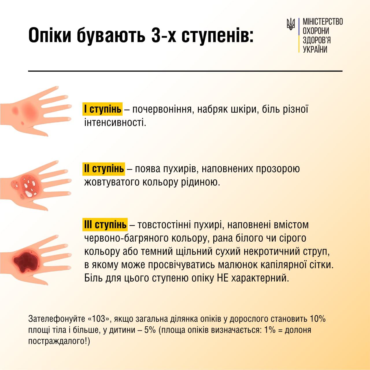 Как быстро помочь при ожогах: медики дали четкий алгоритм действий