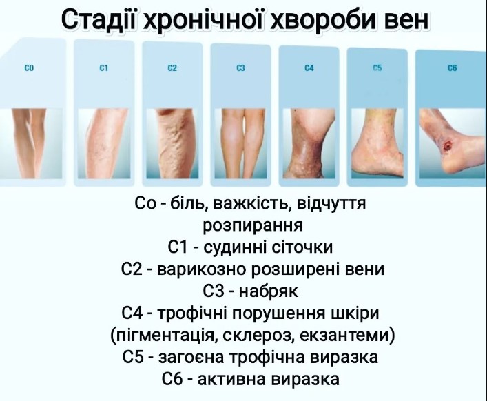 Стадии варикоза: когда можно пролечить, а когда необходима операция