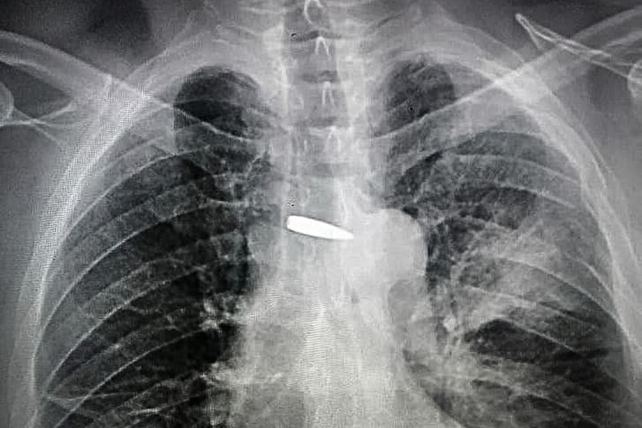 Кулю знайшли у серця. Військовий із Покровська повернувся на фронт після тяжкого поранення: зворушлива історія