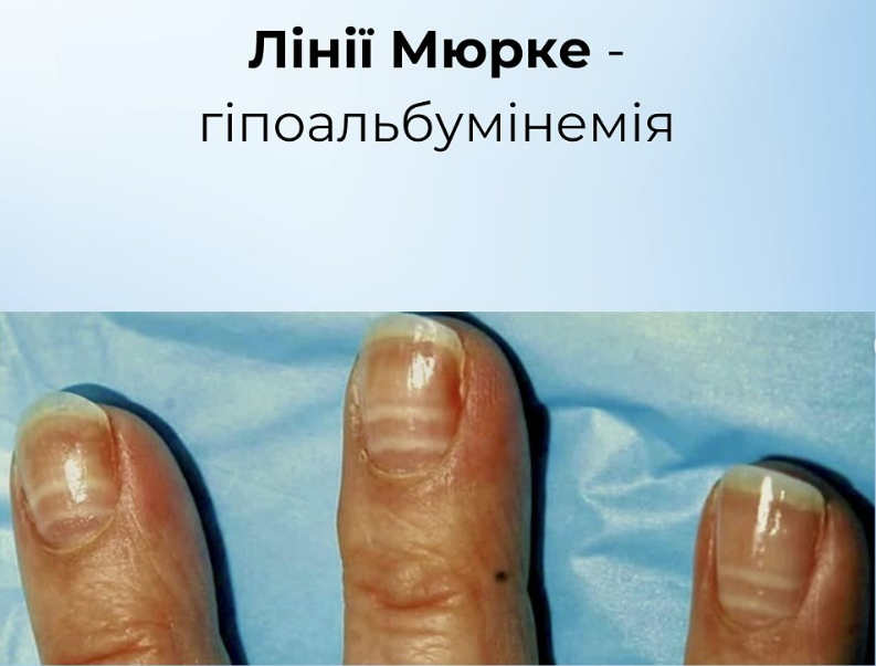На проблему укажут ногти: как распознать пищевые дефициты и вернуть себе здоровье