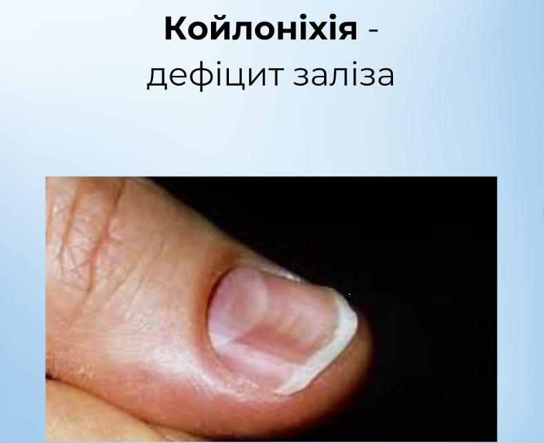 На проблему укажут ногти: как распознать пищевые дефициты и вернуть себе здоровье