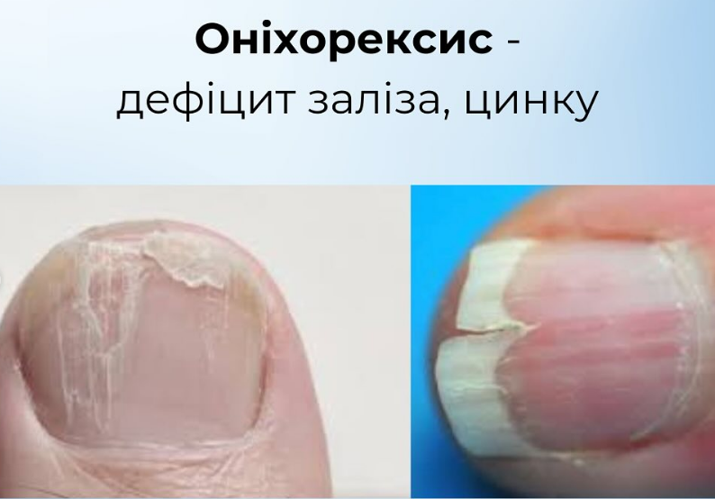 На проблему укажут ногти: как распознать пищевые дефициты и вернуть себе здоровье