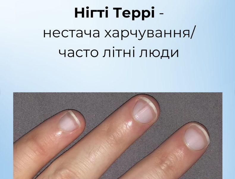 На проблему укажут ногти: как распознать пищевые дефициты и вернуть себе здоровье