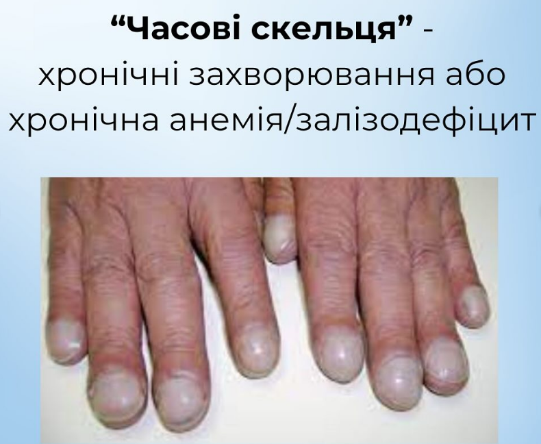 На проблему укажут ногти: как распознать пищевые дефициты и вернуть себе здоровье