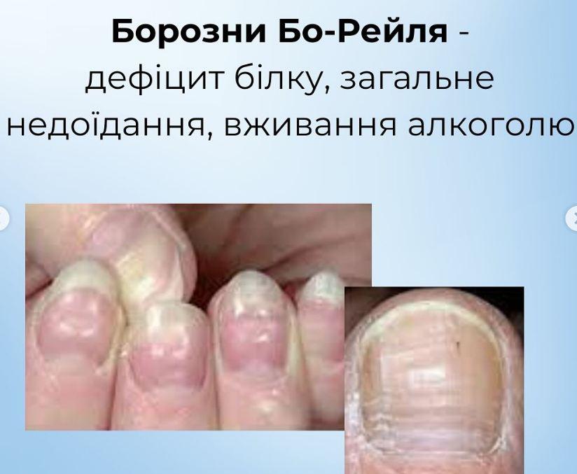 На проблему укажут ногти: как распознать пищевые дефициты и вернуть себе здоровье